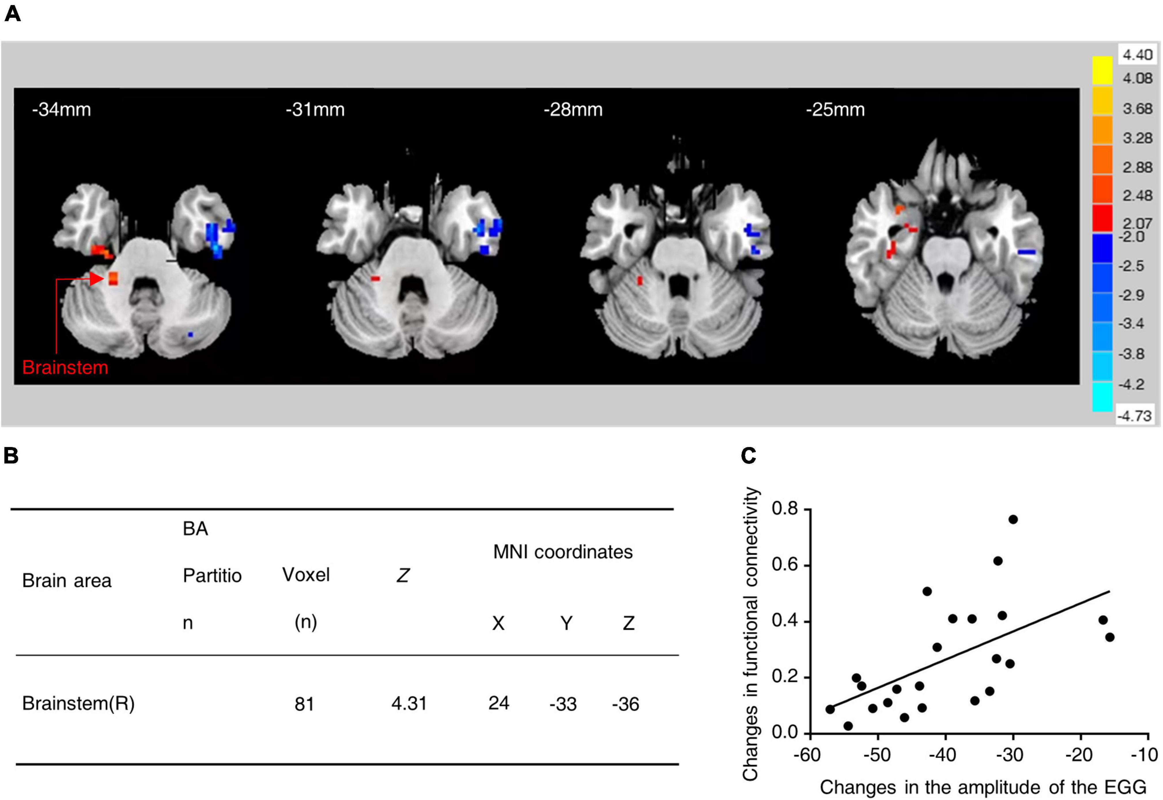 A neural circuit for gastric motility disorders driven by gastric dilation in mice